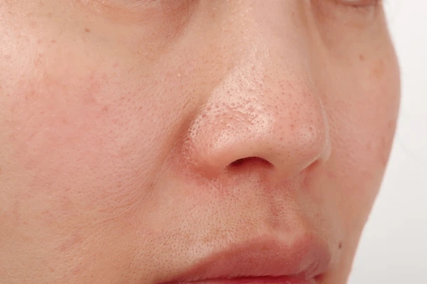 open pores Treatment in Lucknow